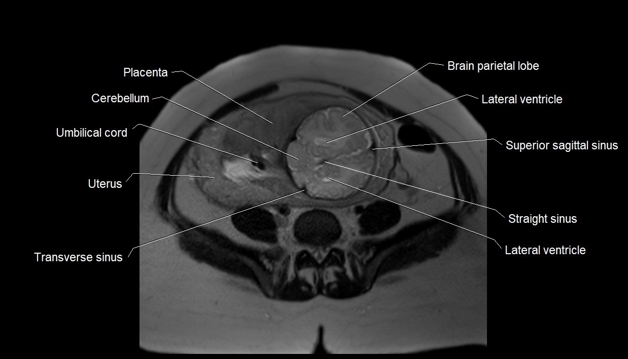 MRI fetal anatomy axial image 24.webp